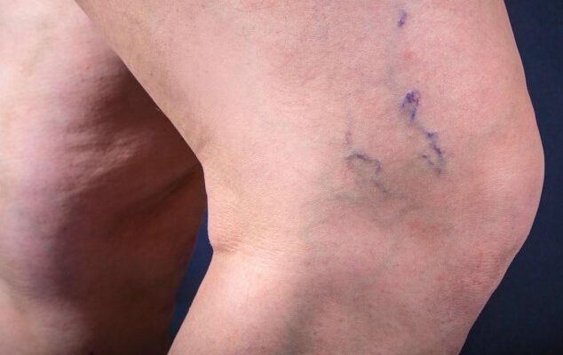 O fim das varizes, como acabar com elas? 2 O fim das varizes, como acabar com elas?